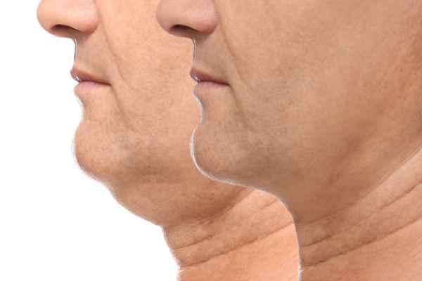 HIFU - Breakthrough in Anti - ageing 2 hifu results Daventry