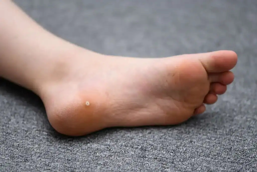 Cryotherapy For Warts And Also Verrucas 2 Image of verruca on the bottom of the foot that able to be treated with Cryotherapy Daventry