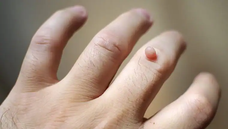 Cryotherapy For Warts And Also Verrucas 1 Image of blemish that Cryotherapy Daventry can remove with Lipo 360.