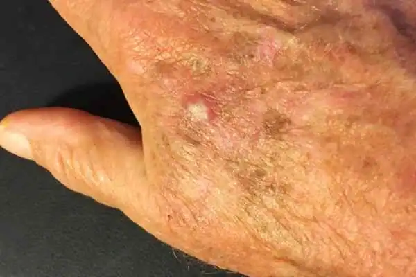 Image of Actinic keratoses Daventry on a person hand
