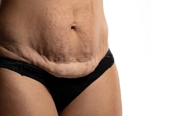 The Science of Skin Tightening 1 The science behind skin tightening Daventry picture of a woman's sagging skin on the stomach